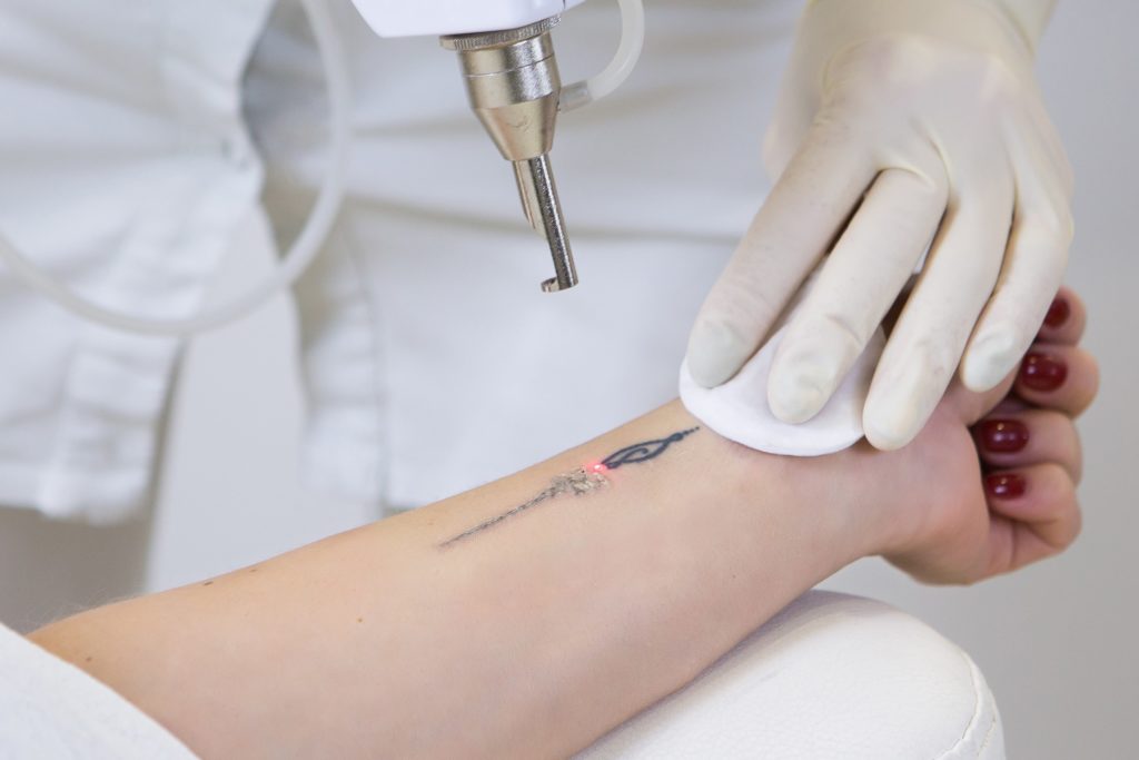 Young Woman Getting Laser Tattoo Removal Treatment on the Hand | Purely Natural Medical Spa in Brooklyn, NY