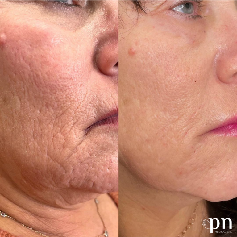 Morpheus8 for Skin Tightening and Texture