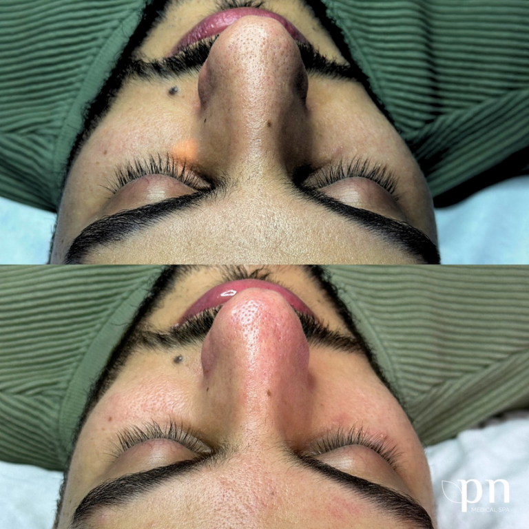 Deep-Cleansing Hydrafacial