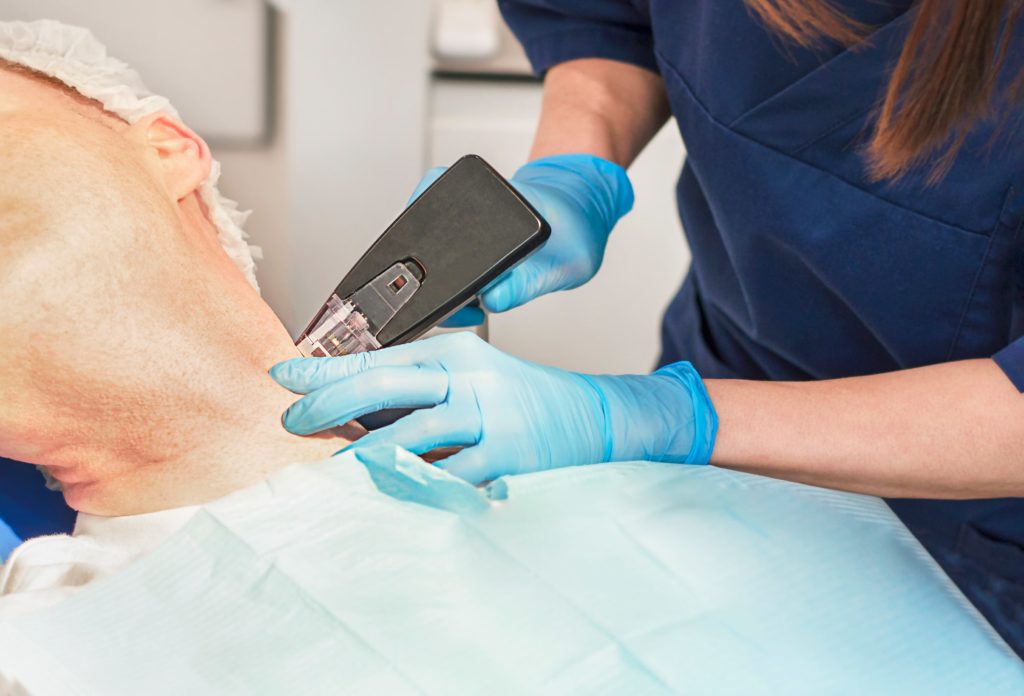 Morpheus8: The New Nonsurgical Facelift Everyone is Talking About